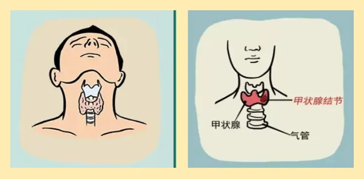 1666145154127719.jpg 杭州看结节好的中医:了解甲状腺结节的危害